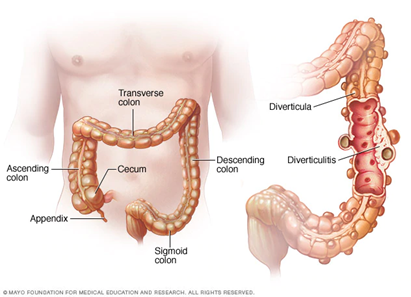 Divertikula pada usus besar. Gambar: Mayo Foundation