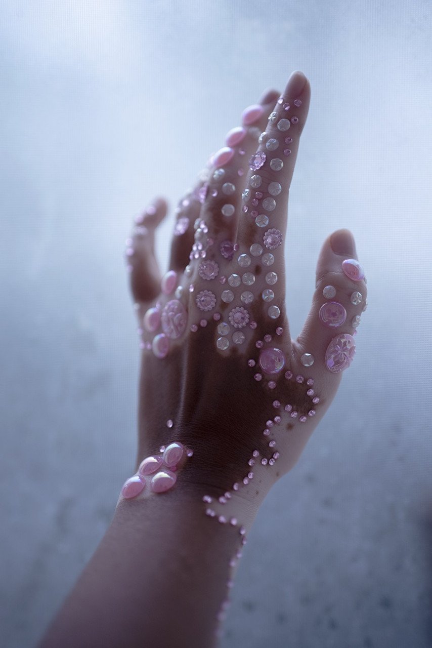 Nadirah memilih untuk menjadikan Vitiligo sebagai salah satu subjek fotografinya untuk menolong ramai menghidap Vitiligo melihat kecantikan di balik kekurangan.