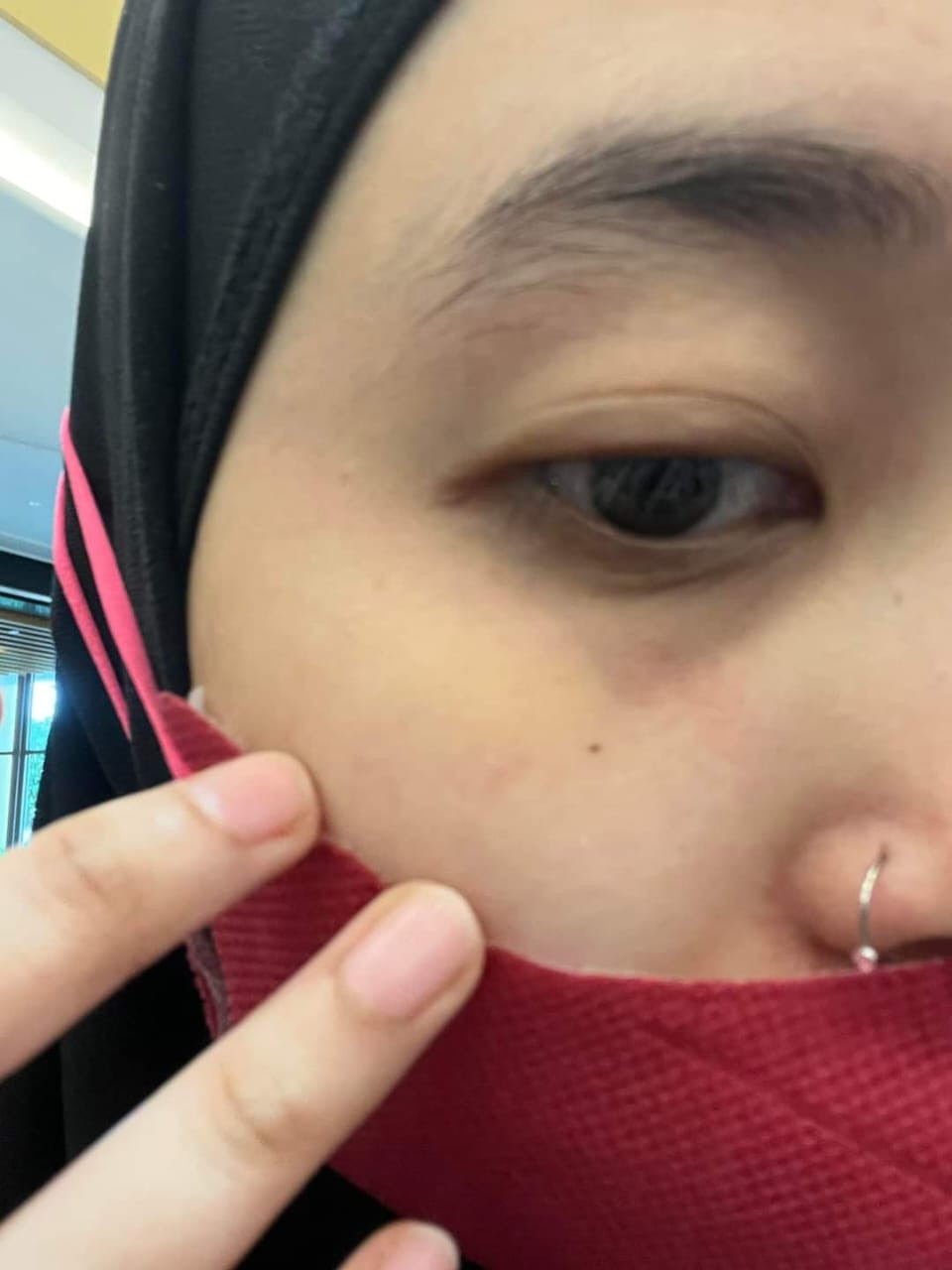 Zuriani menunjukkan kecederaan dialami. - gambar media sosial