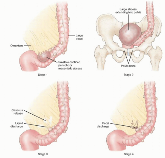 Tahap Radang Divertikulitis. Gambar: Hinchey et al