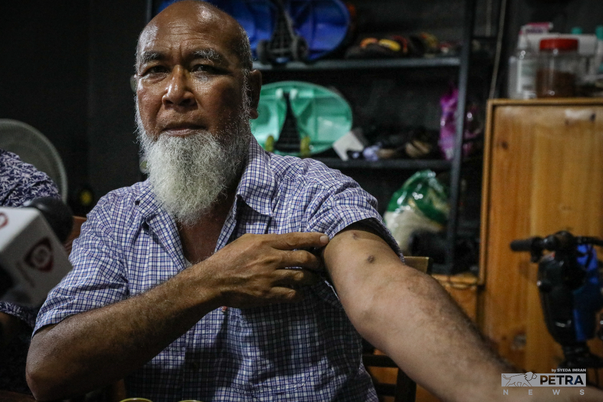 Zainoldin menunjukkan kecederaan yang dialaminya dalam serangan berkenaan. - Gambar oleh Syeda Imran