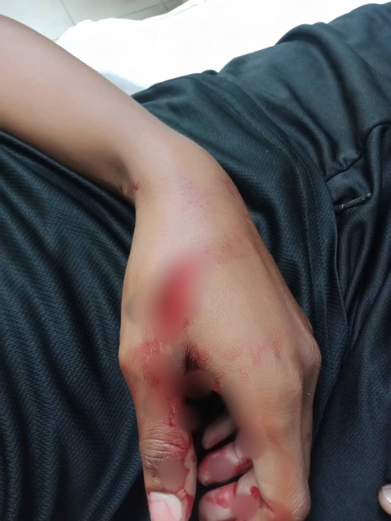Salah seorang anggota polis yang mengalami kecederaan di bahagian tangan akibat ditetak oleh seorang lelaki dipercayai pesakit mental.