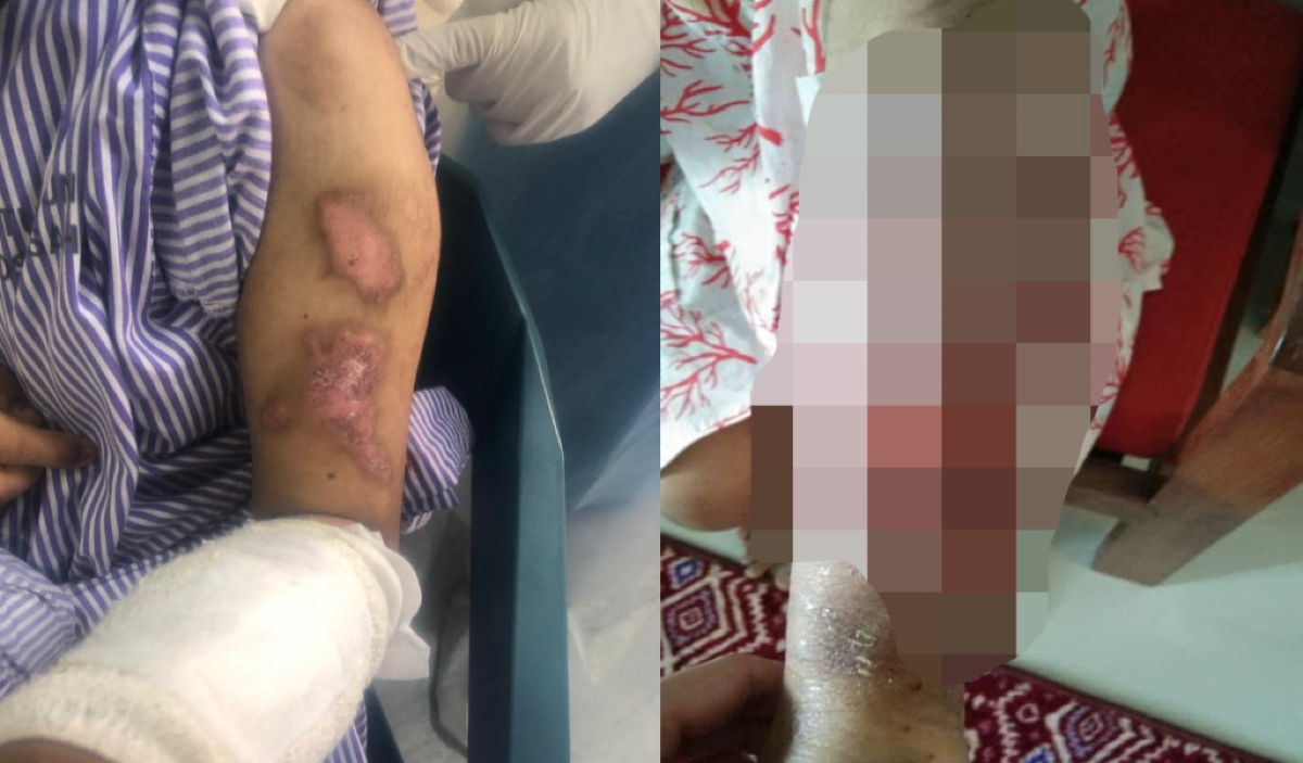 Kecederaan yang dialami oleh Bella terlalu sakit untuk ditanggung seorang kanak-kanak, hingga kesan kekalnya akan menyebabkan trauma dari segi mental, emosi dan fizikal mangsa - Gambar Fail