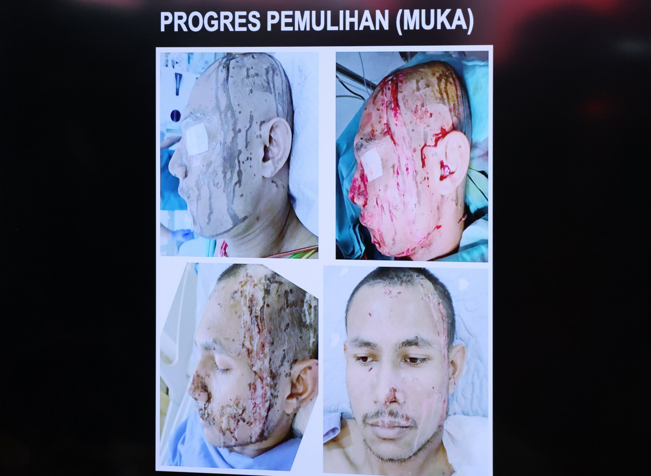 Kesan kecederaan dan proses pemulihan dilalui Faisal Halim - Gambar Afif Abd Halim