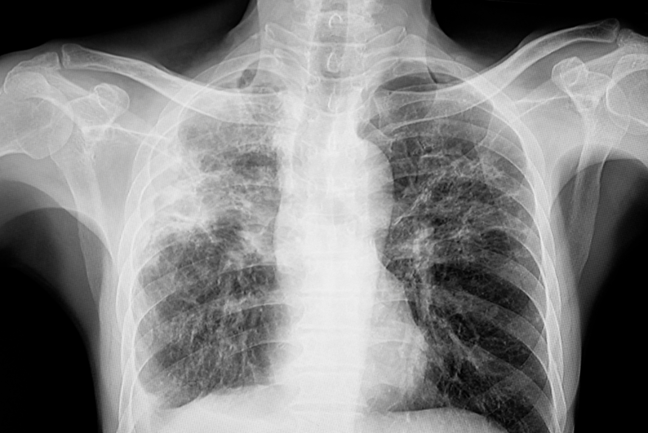 X-ray dada menunjukkan tuberkulosis paru-paru (TB) dengan penglibatan utama di lobus atas, yang boleh melibatkan paru-paru kiri, kanan atau kedua-duanya