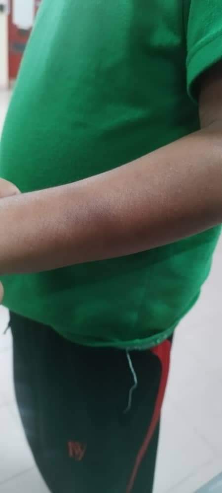 Tangan mangsa turut lebam dibelasah - gambar Facebook