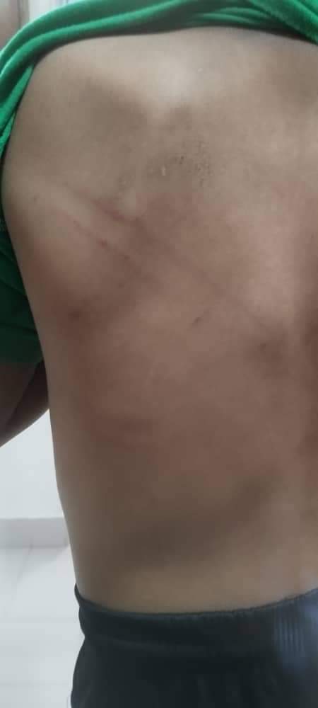 Kesan lebam pada badan mangsa - gambar Facebook